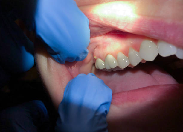 Best Emergency Dentist for Lost Fillings or Crowns in Needville, TX